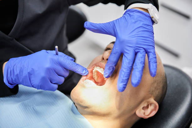 Emergency Dental Filling Replacement in LA